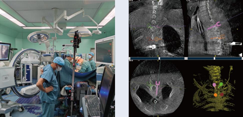 三維C臂與骨科導(dǎo)航機器人配合應(yīng)用(助力骨科手術(shù)更準(zhǔn)確)