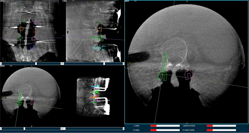 機器人輔助腰椎后路側彎矯形手術規(guī)劃圖像